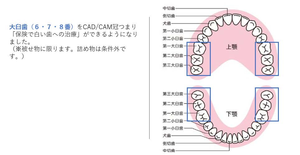 【CAD/CAM冠治療】大阪で奥歯も保険で白い歯なら江並歯科へ