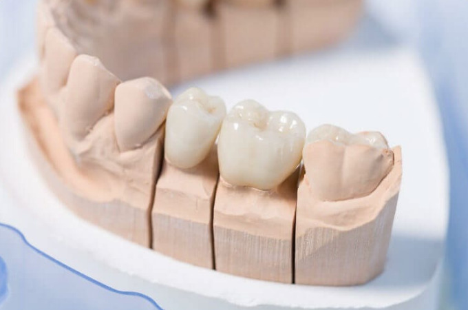 CAD/CAM冠治療（保険で白い歯）